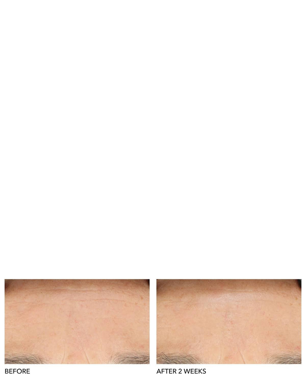Clinical Grade Resurfacing Liquid Peel Y680