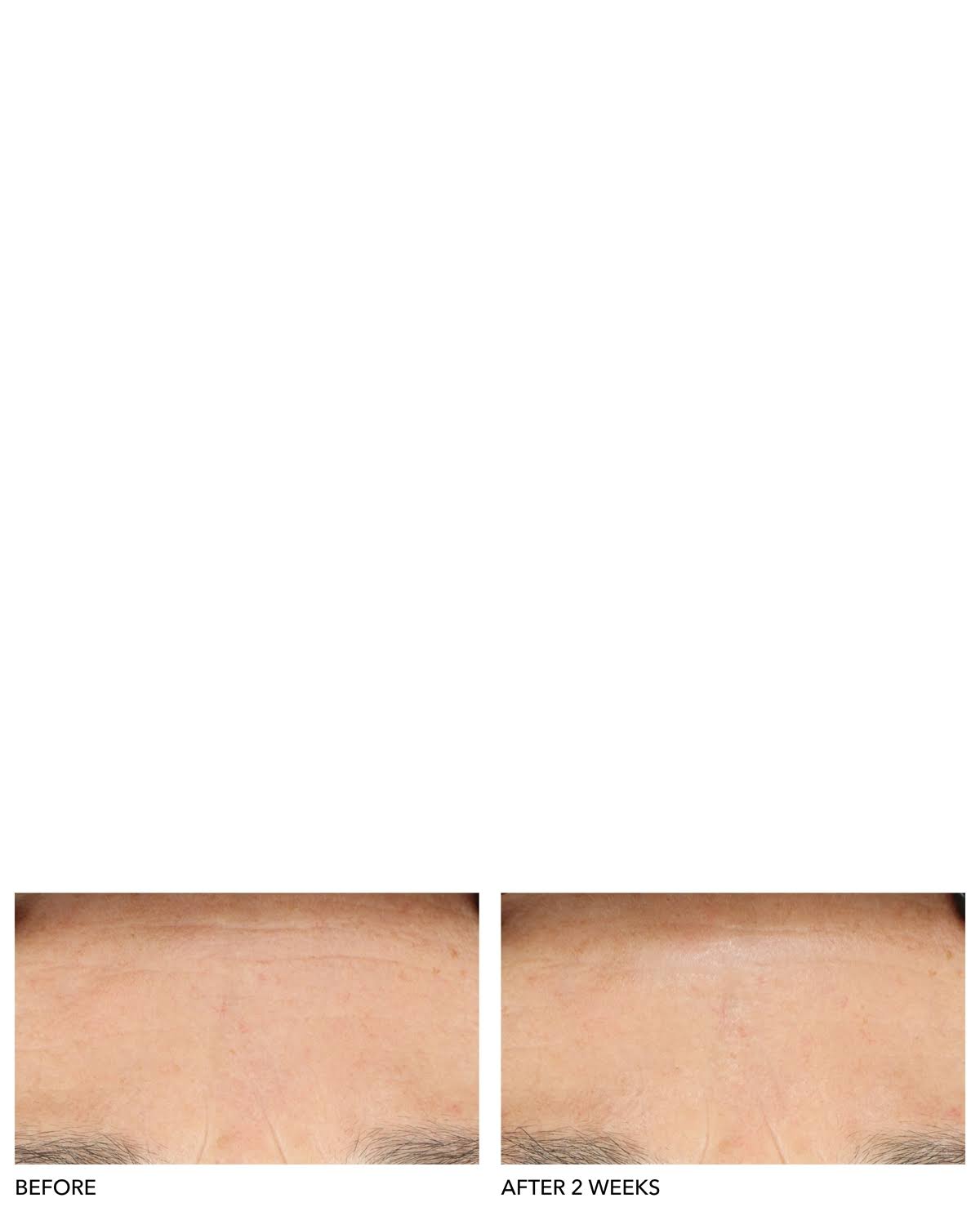 Clinical Grade Resurfacing Liquid Peel Y680