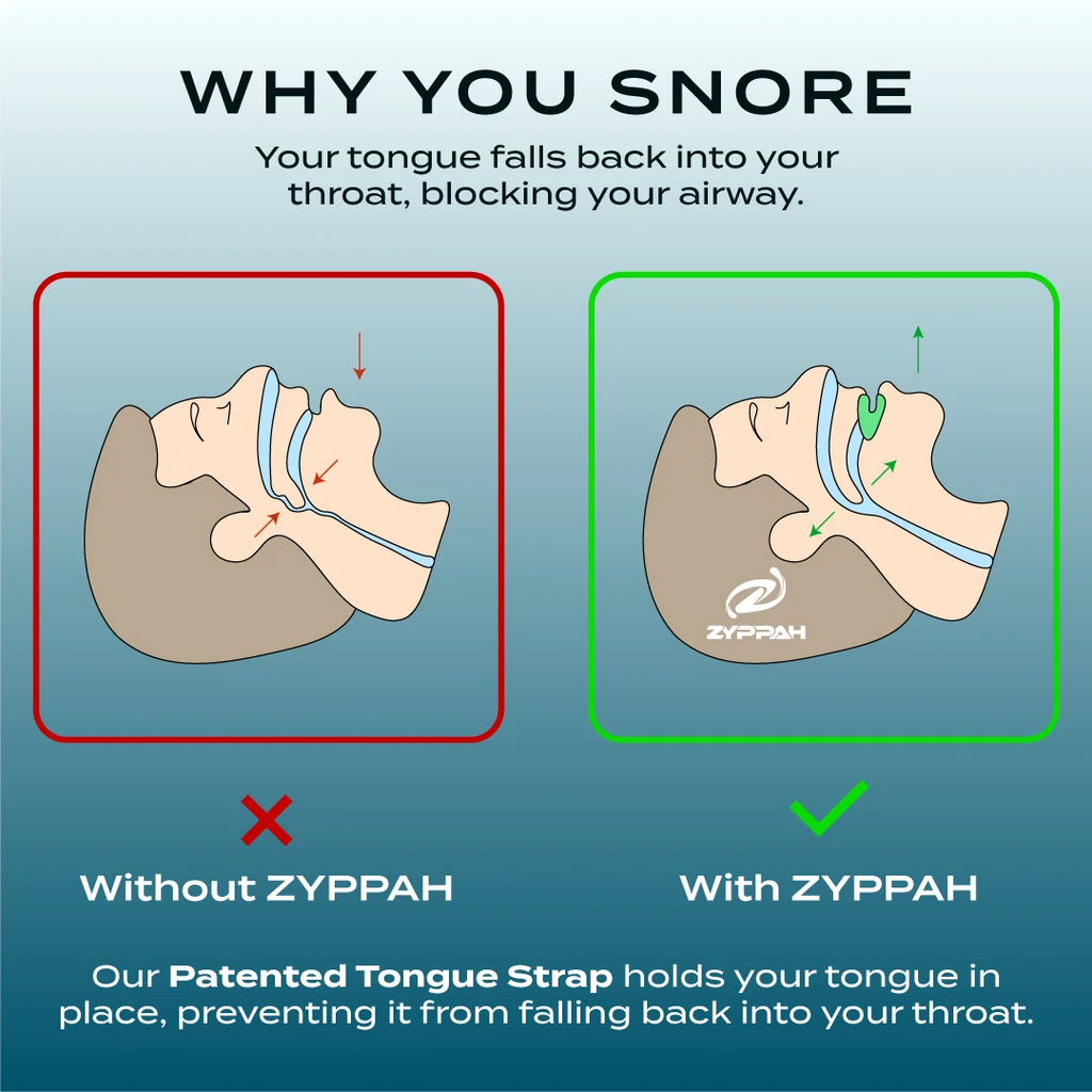 Anti Snoring Hybrid Oral Appliance E1101
