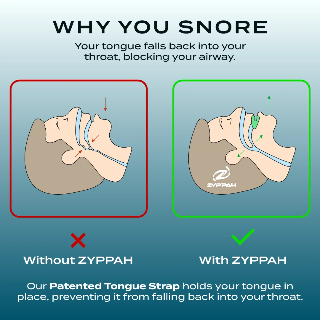 Anti Snoring Hybrid Oral Appliance E1101